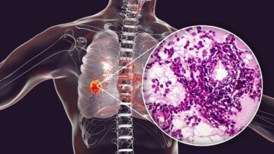 does cancer spread faster after biopsy